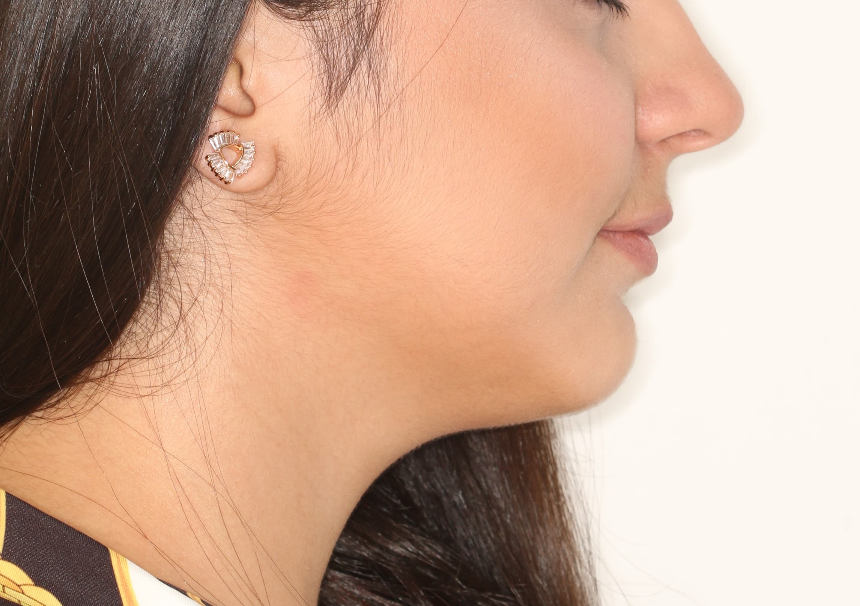 Case 1 Face Side view After