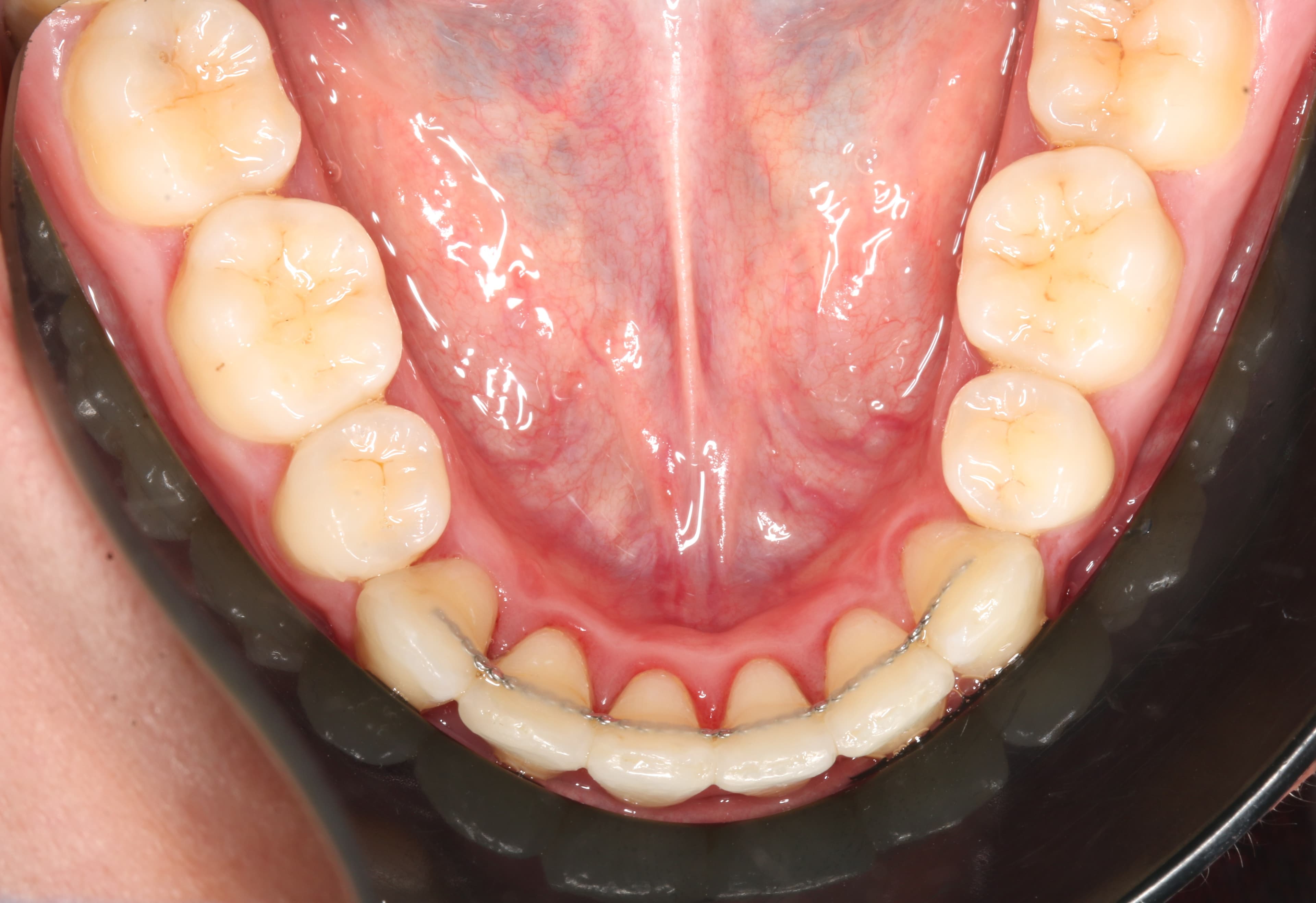 Case 2 Lower Occlusal view After