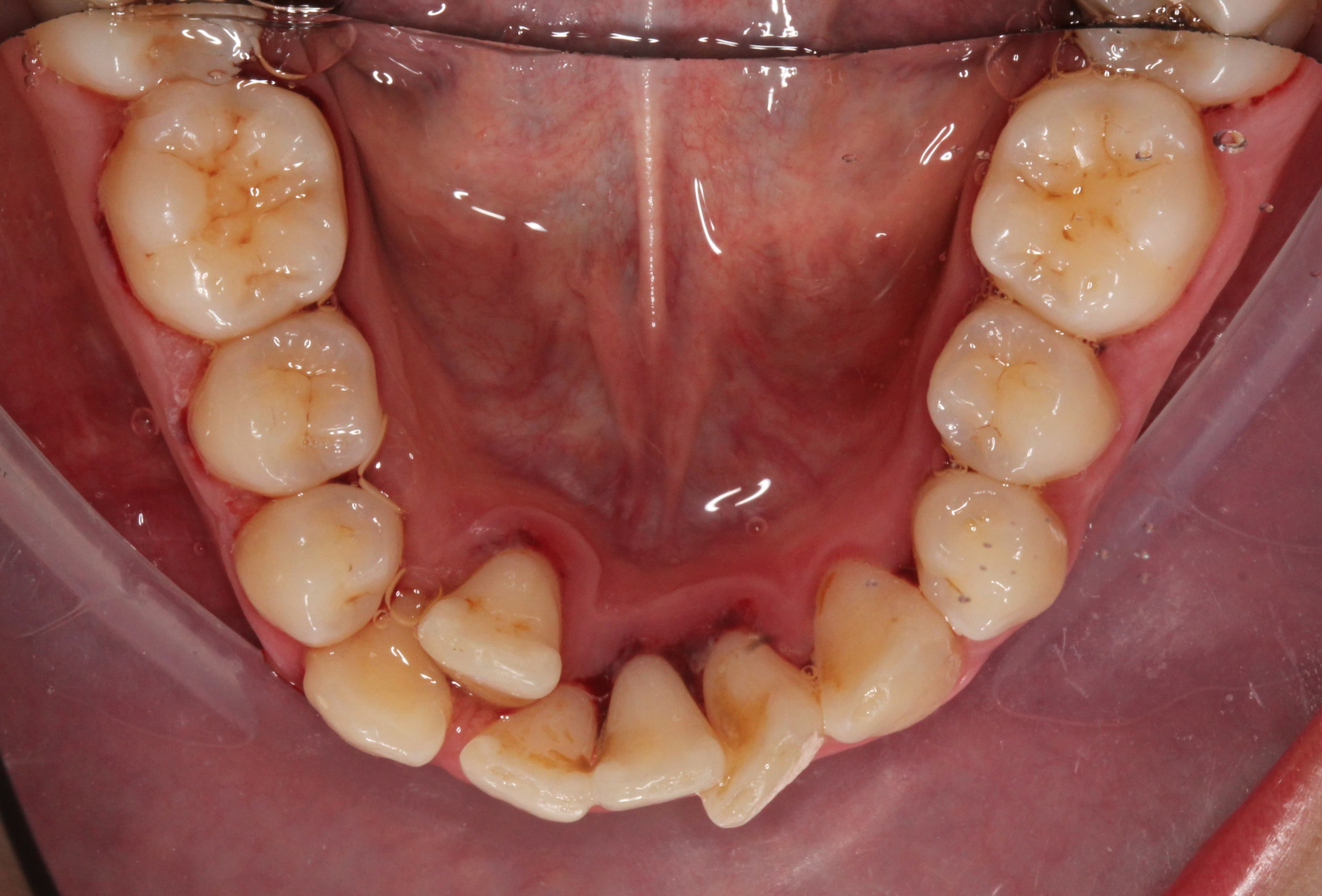 Case 2 Lower Occlusal view Before
