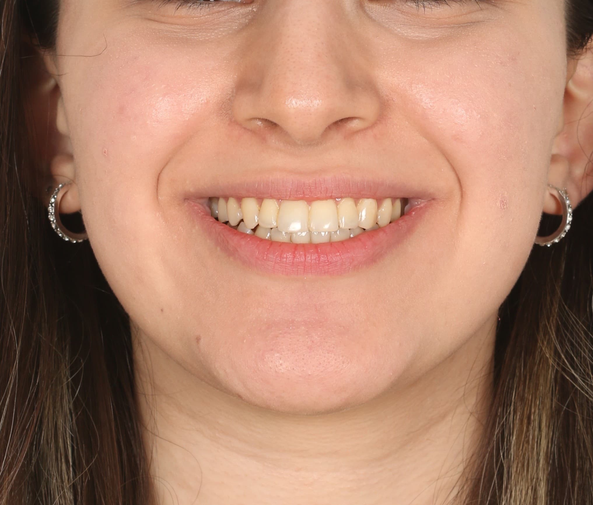 Case 3 Face Front view After