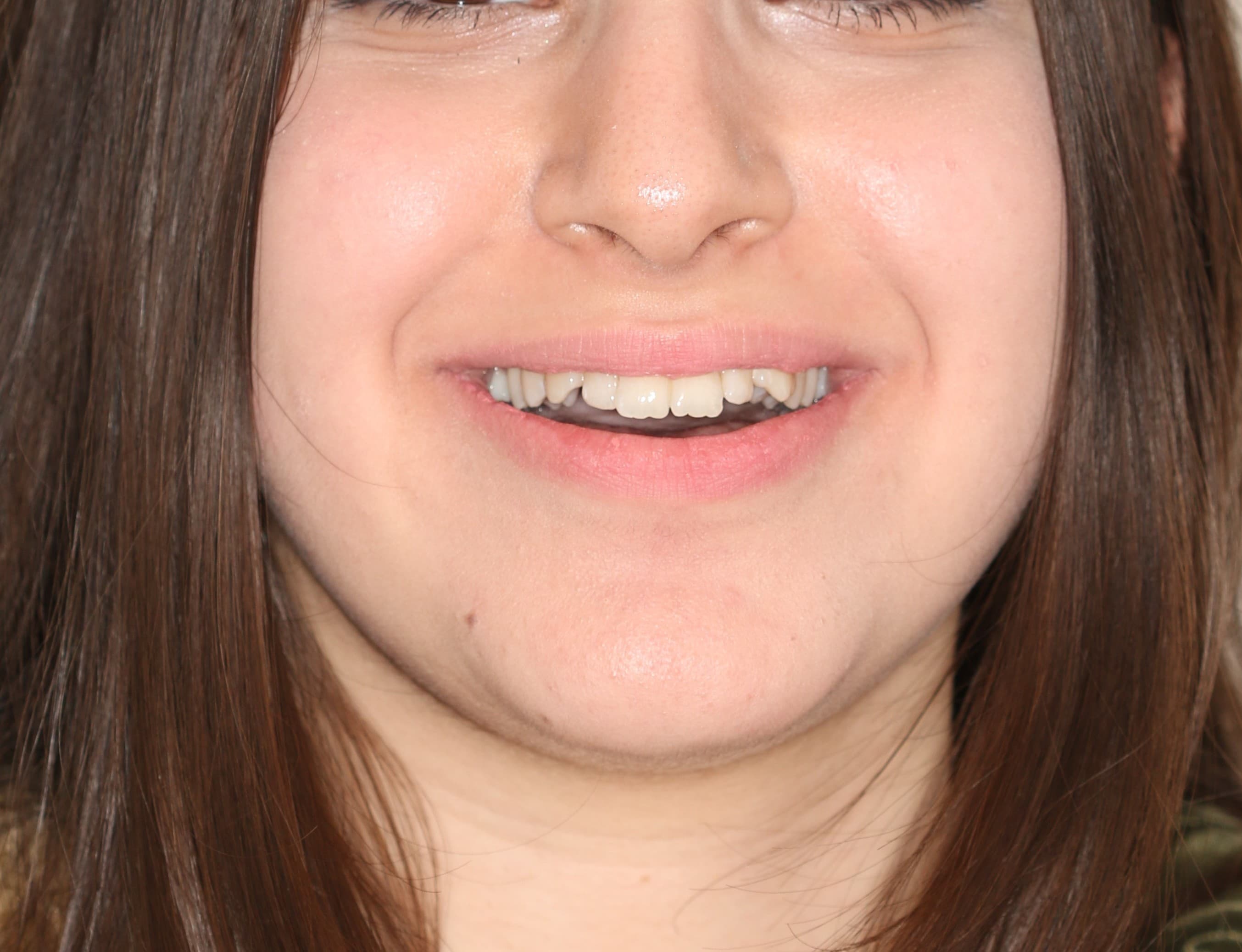 Case 3 Face Front view Before